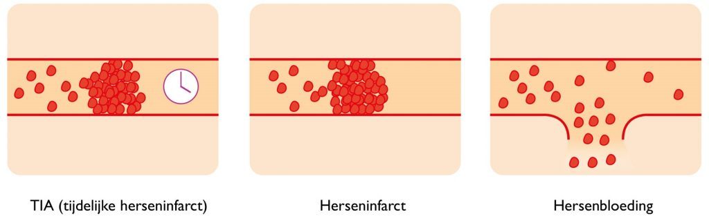 TIA Herseninfarct Hersenbloeding
