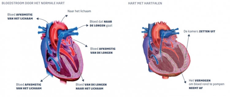 Hartfalen en hartrevalidatie Apeldoorn
