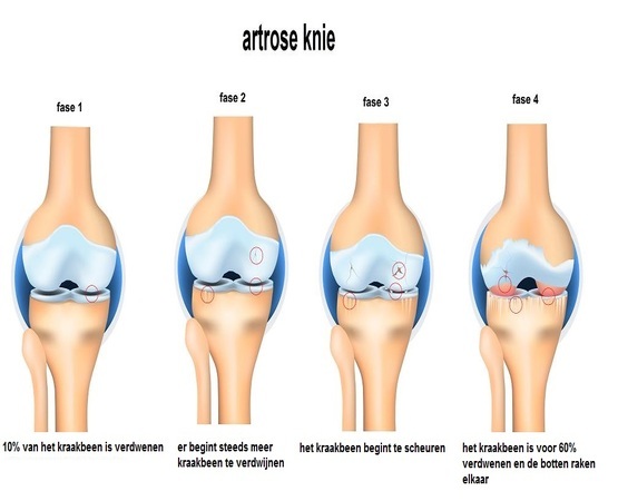 Knie Artrose Kraakbeen